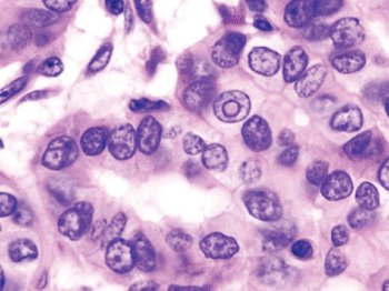 Image: Histopathology of thyroid gland carcinoma (Photo courtesy of Free Software Foundation).